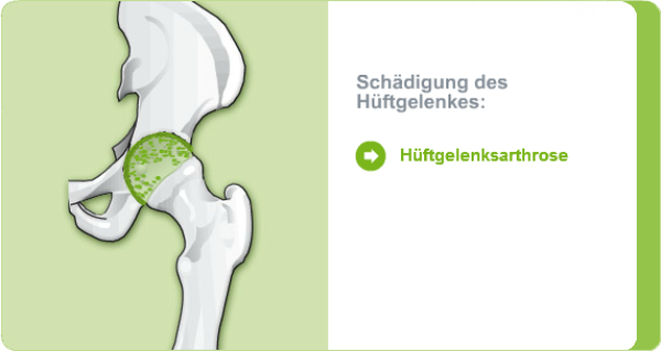 Illustration: Schädigung des Hüftgelenks durch eine Hüftgelenksarthrose