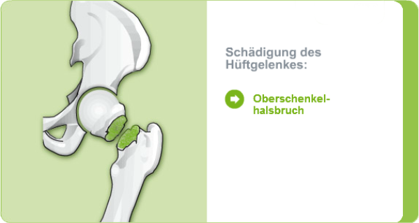 Illustration: Schädigung des Hüftgelenks durch eine Oberschenkelhalsbruch