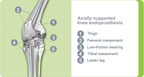 Axially supported knee replacement