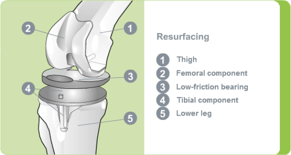 Knee resurfacing