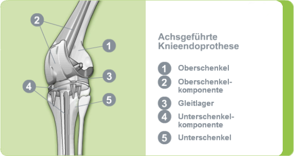 Illustration: Achsgeführte Knieendoprothese