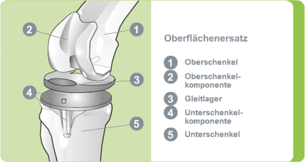 Illustration: Oberflächenersatz Kniegelenk