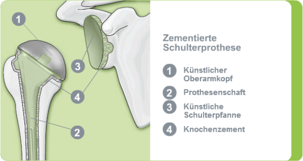 Illustration einer zementierten Schulterprothese