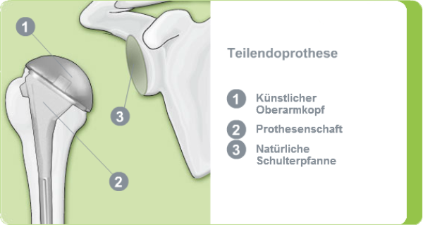 Illustration einer Teilendoprothese des Schultergelenks