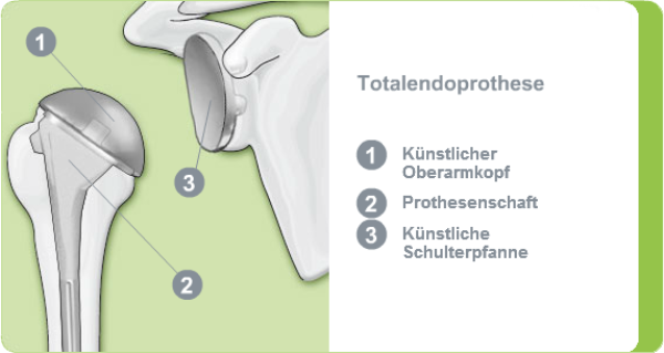 Illustration einer Totalendoprothese Schultergelenks